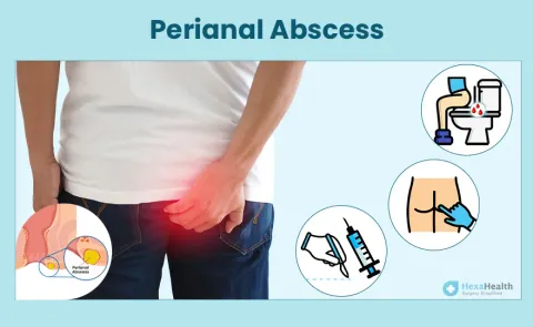 Perianal Abscess: Symptoms, Causes, and Treatment